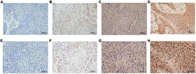 The effect of SMAD4 on the prognosis and immune response in hypopharyngeal carcinoma